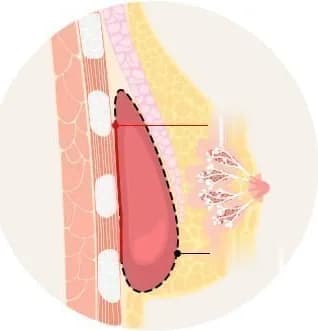 被膜を部分的に除去する範囲を示した断面図