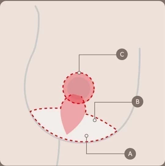 胸のリフトにおける切開と移動方向を示した図