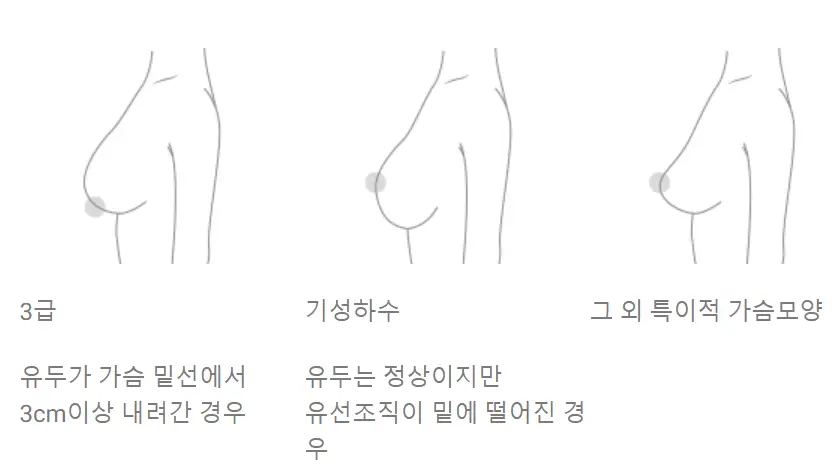 乳房リフト(挙上)手術の費用?先に価格を調べても意味がない理由。 — 本文画像 4