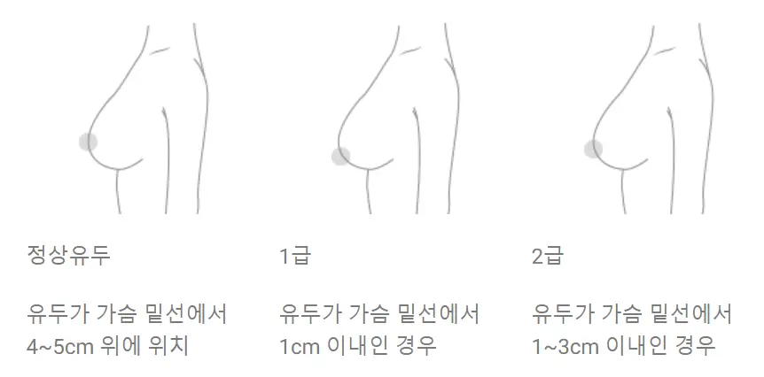 乳房リフト(挙上)手術の費用?先に価格を調べても意味がない理由。 — 本文画像 3