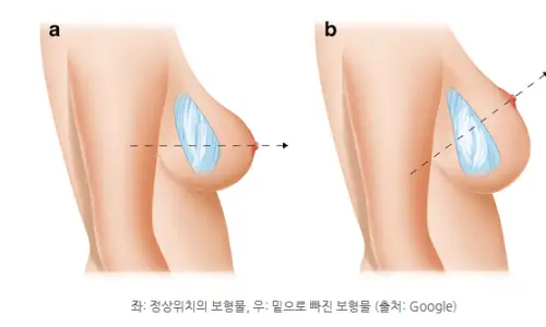 バスト底落ち(ボトミングアウト)の再手術?ワキ切開/アンダーバスト切開別の方法総まとめ―20年の研究経験からのアドバイス — 본문 이미지