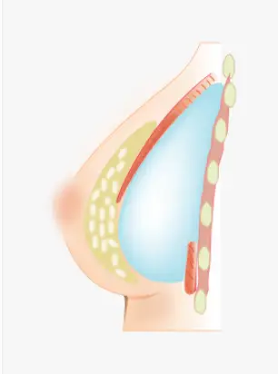 胸がとても小さい方の豊胸手術、インプラントを入れたら目立ちすぎない?<実際の研究資料をもとにしたアドバイス> — 本文画像 5