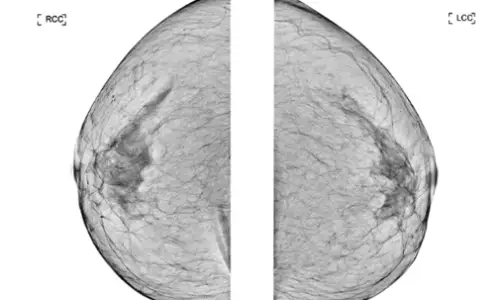 胸の手術と母乳育児?豊胸・縮小・リフトごとの可否まとめ<乳腺外科専門医が在籍するクリニックからのアドバイス> — 本文画像 11