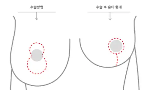 垂れた胸の手術費用について、リフト術/インプラントが必要なケースも整理してご説明します。<20年の研究経験からのアドバイス> — 本文画像 5