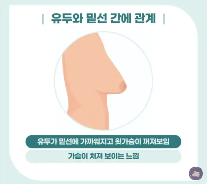 垂れた胸の手術費用は?口コミにもだまされないでください。 — 本文画像 4