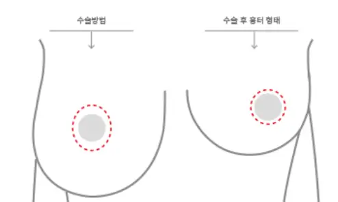 垂れた胸の手術費用について、リフト術/インプラントが必要なケースも整理してご説明します。<20年の研究経験からのアドバイス> — 本文画像 6