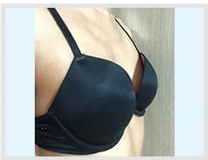 バスト手術前の側面写真3