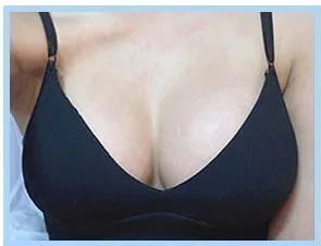 バスト手術3週間後の写真4