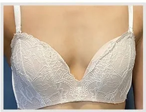 バスト手術前の写真4