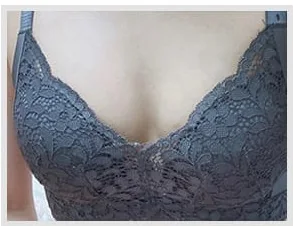 バスト手術前の写真5
