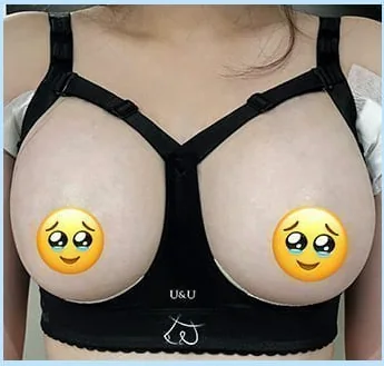 バスト手術2日目、補正ブラ着用の正面写真2