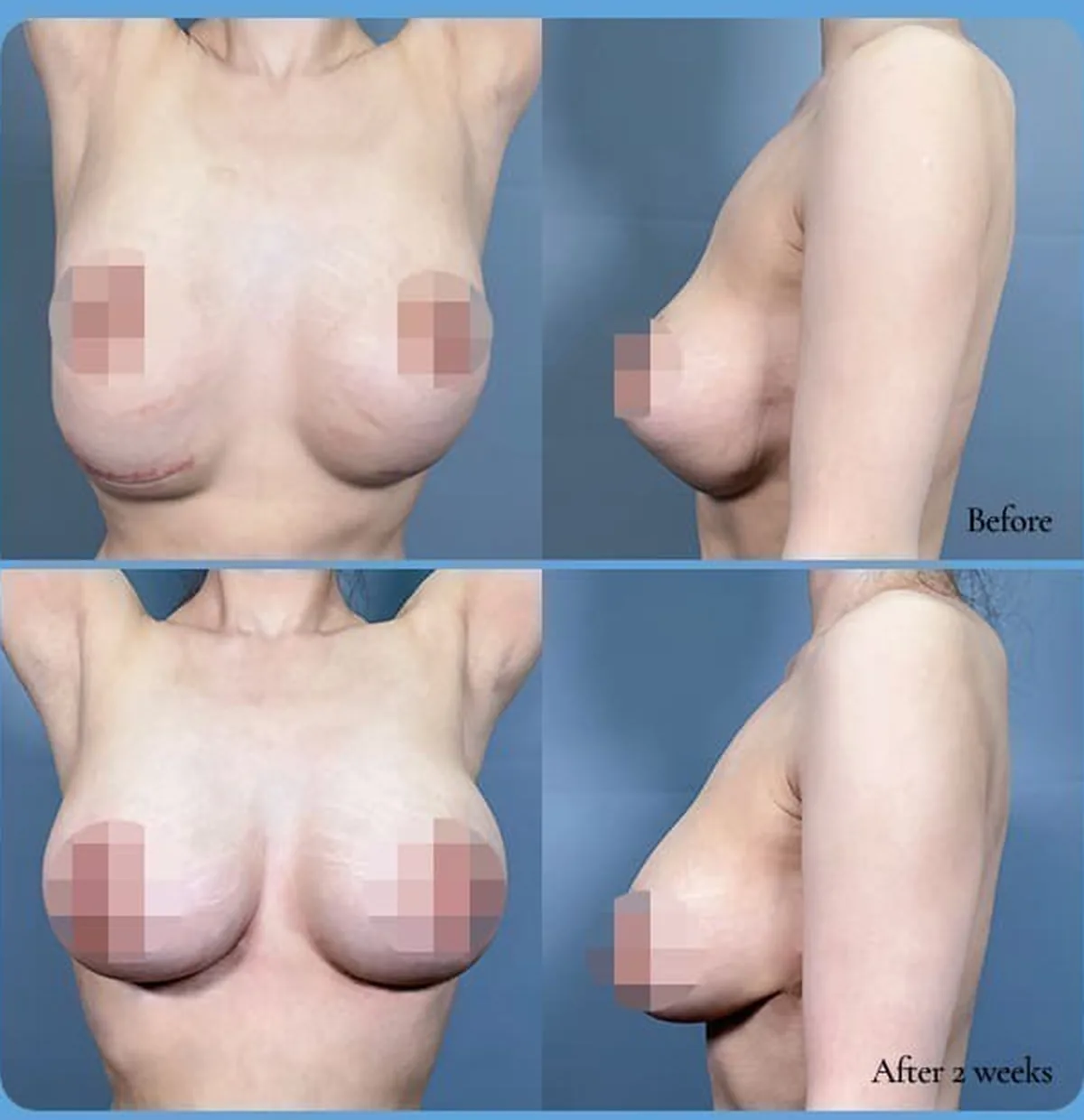 ボトムアウト再手術の術前術後比較写真 — Before / After 2 weeks(正面・側面)
