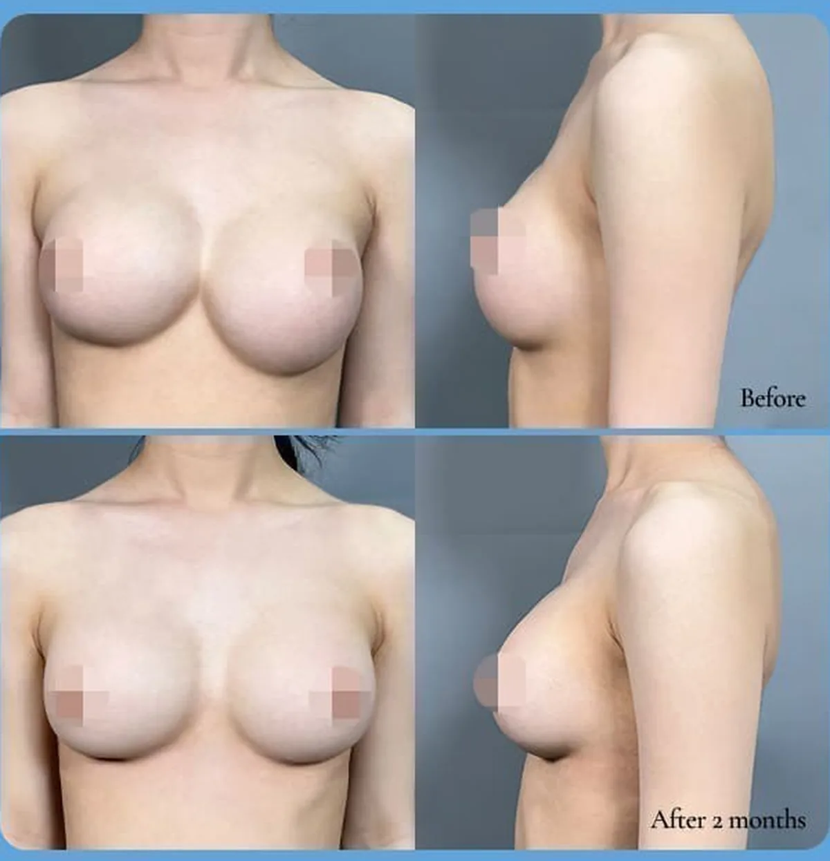 前方偏位(合体胸)・ボトムアウト再手術の術前術後比較写真 — Before / After 2 months(正面・側面)