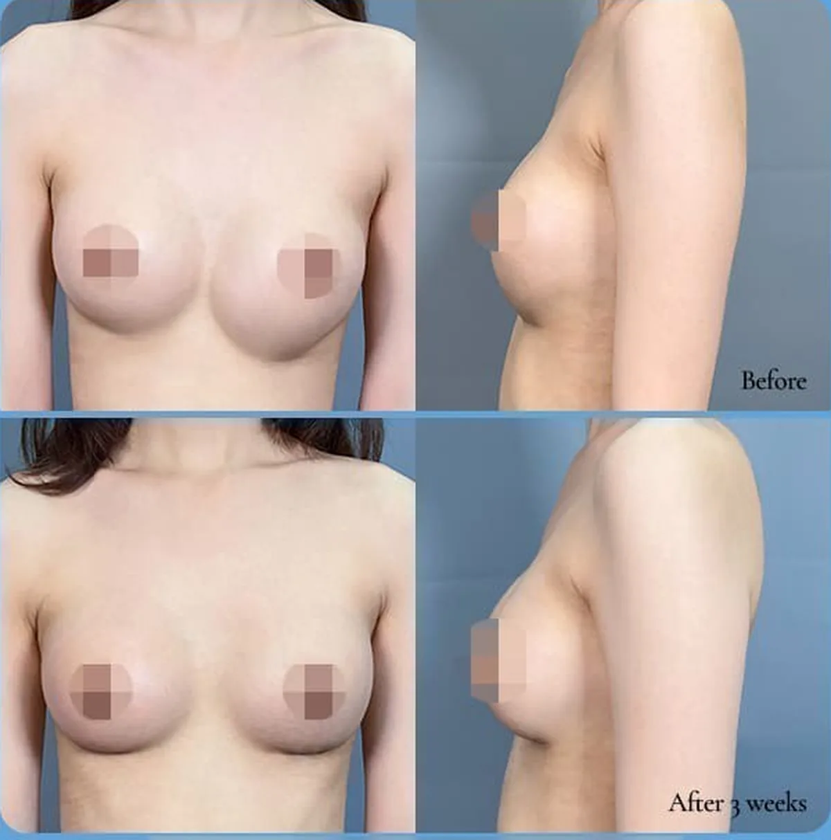 ボトムアウトによる左右非対称の再手術術前術後比較写真 — Before / After 3 weeks(正面・側面)