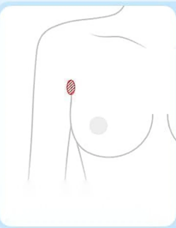 ワキの切開位置を示した図解