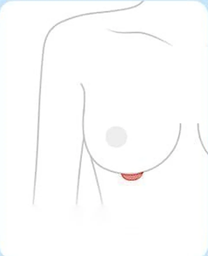 胸の下乳房線の切開位置を示した図解