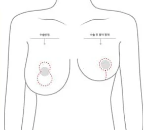 垂直切開の位置と術後の傷跡の形を示した上半身の図解