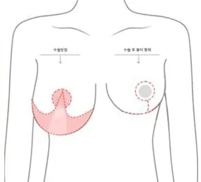 O字切開の範囲と術後の傷跡の形を示した上半身の図解