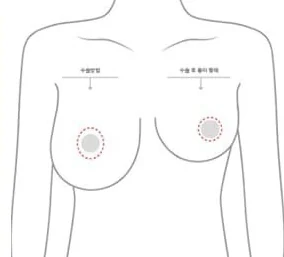 乳輪切開の位置と術後の傷跡の形を示した上半身の図解