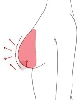 インプラント挿入とともに乳頭の位置を上げる胸リフトの側面図解