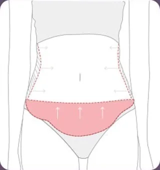 腹部全体の脂肪吸引を行う範囲を示した図解