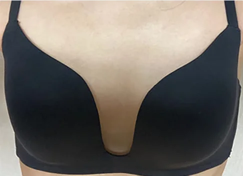 バスト整形前の写真 7