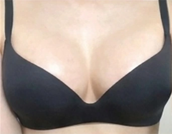 豊胸後のブラ着用写真 1
