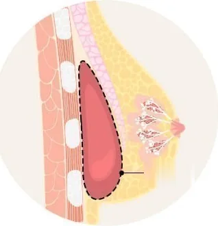 被膜をすべて除去して新しい被膜が形成される過程を描いた乳房断面図