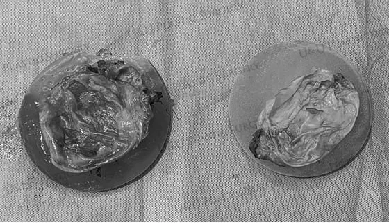 摘出物の写真 — 除去した被膜とインプラントの内容物をトレイに入れたもの