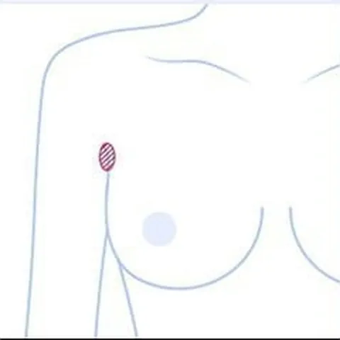 腋窩切開の位置を示した上半身イラスト