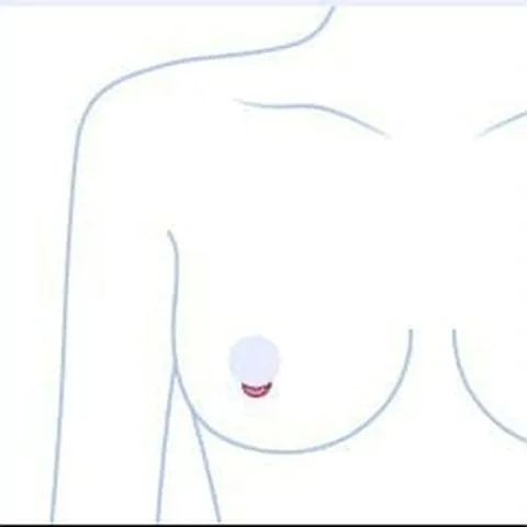 乳輪切開の位置を示した上半身イラスト
