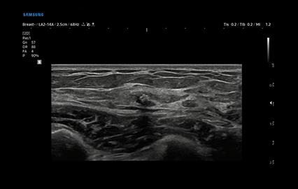 Healthy Breast インプラントエコー img5 m