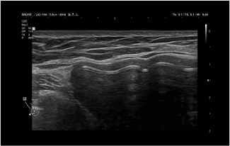 Healthy Breast インプラントエコー img6 m