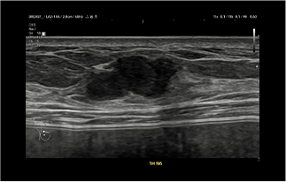 Healthy Breast 乳がんエコー img10 m