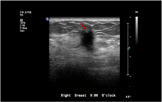 Healthy Breast 乳がんエコー img11 m