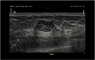 Healthy Breast 乳がんエコー img9 m