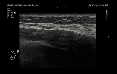 healthy breast インプラントエコー img10