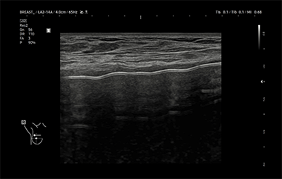healthy breast インプラントエコー img11