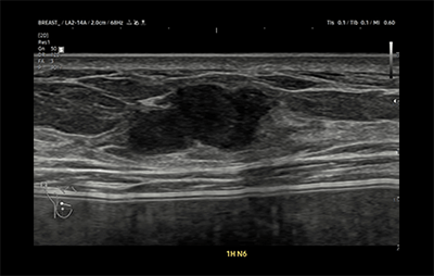 healthy breast 乳がんエコー img8